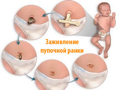 обработать пупок новорожденного