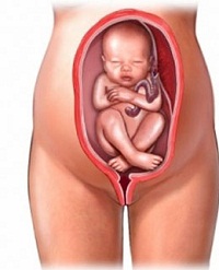 тазовое предлежание плода фото