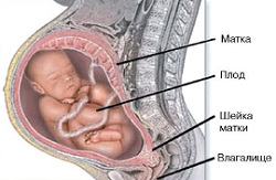тазовое предлежание плода фото