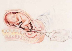 Виды абортов