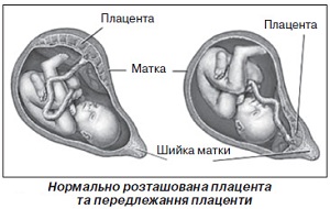 Розкриття шийки матки
